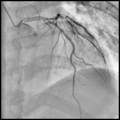 angiography system
