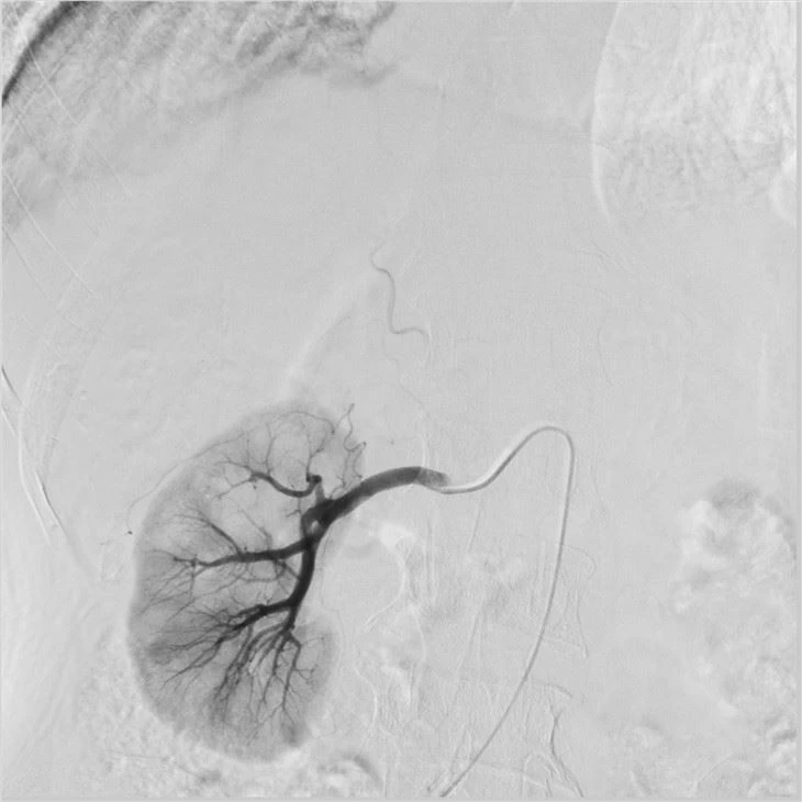 Medical Digital Subtraction Angiography System